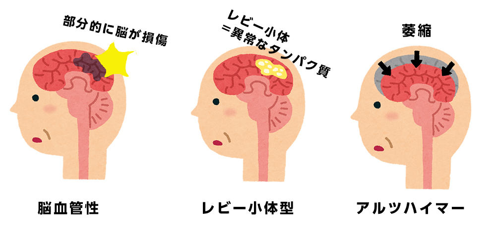 認知症の種類とメカニズム図：脳血管性、レビー小体型、アルツハイマー型